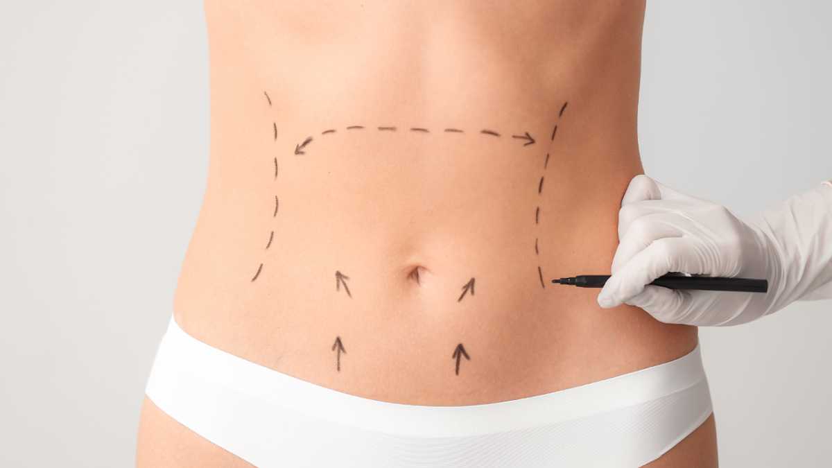 Cirurgia Plástica em Belo Horizonte: A Abdominoplastia como Transformação Física e Emocional