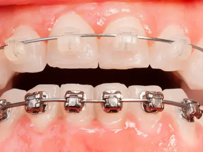 Veja quais são as dicas para corrigir imperfeições nos dentes